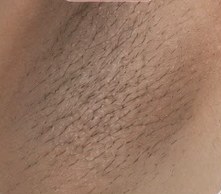 Axila antes da depilação a laser